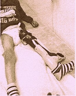 הקטטר הושאר ברגלו של היילוד - והוא נותר נכה לכל החיים. צילום מתוך כתב התביעה