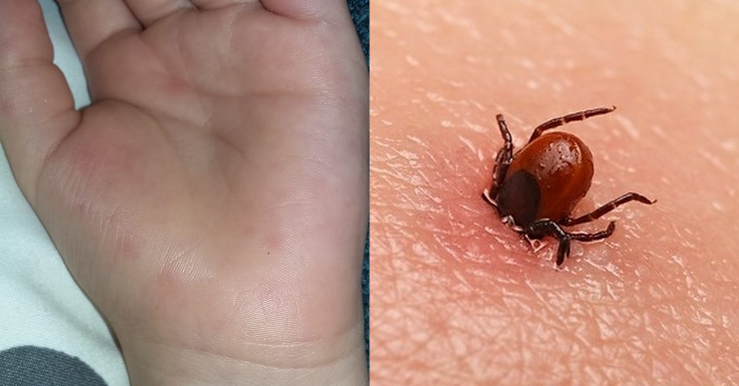 קדחת הבהרות נגרמת מעקיצת קרציה נגועה. צילום: shutterstock. פרטי