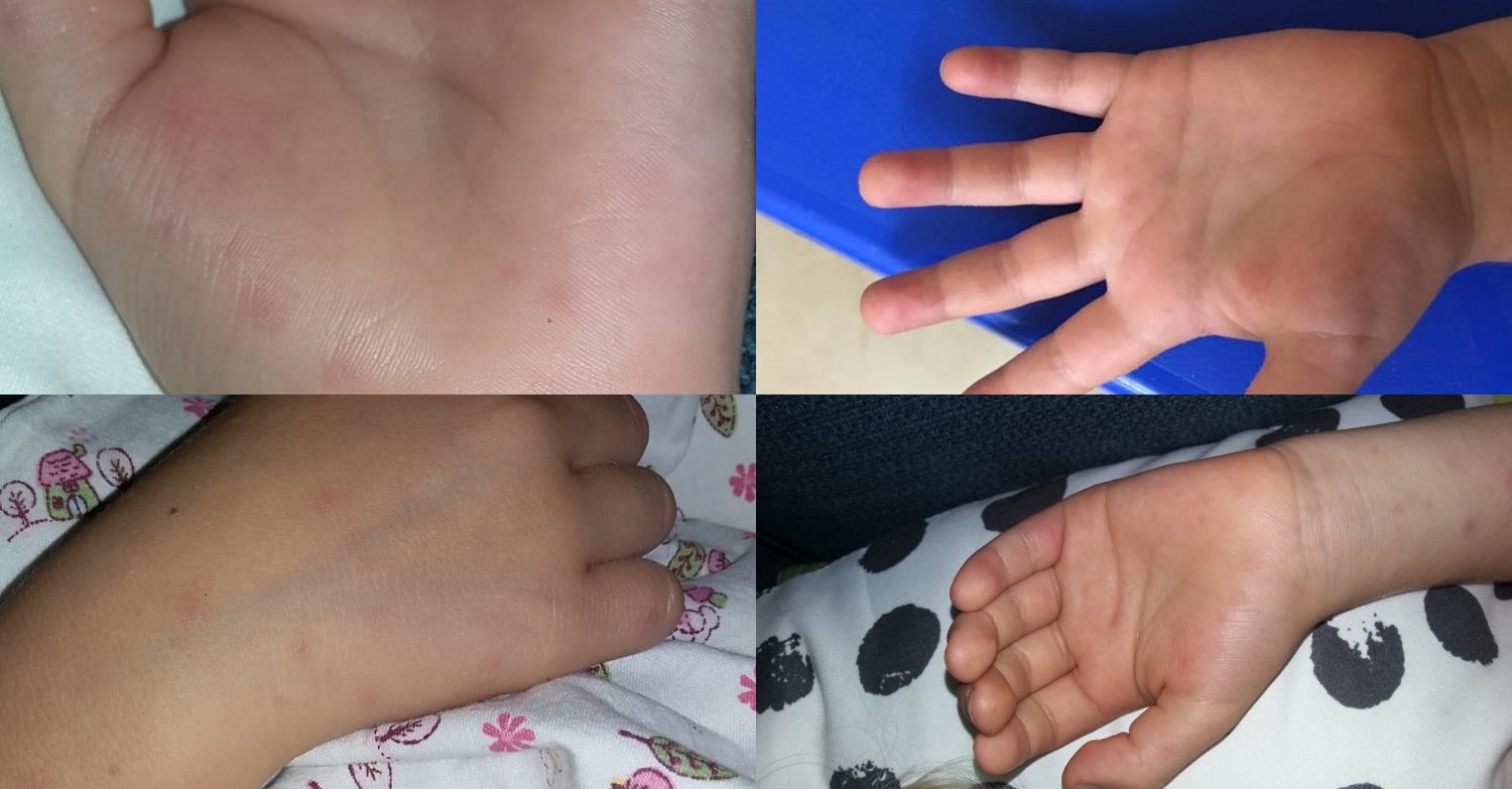 שני מקרים של קדחת הבהרות התגלו בגן ילדים בבאר שבע. צילום: פרטי