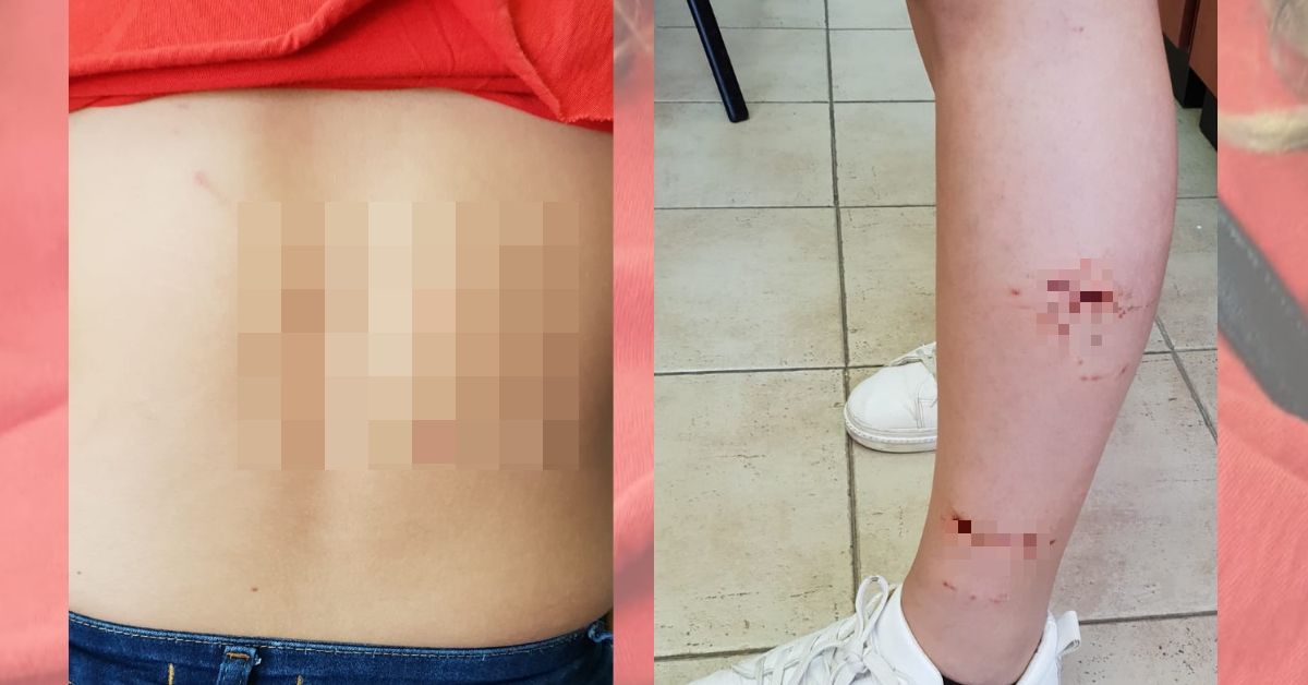 סימני התקיפה | צילום: פרטי