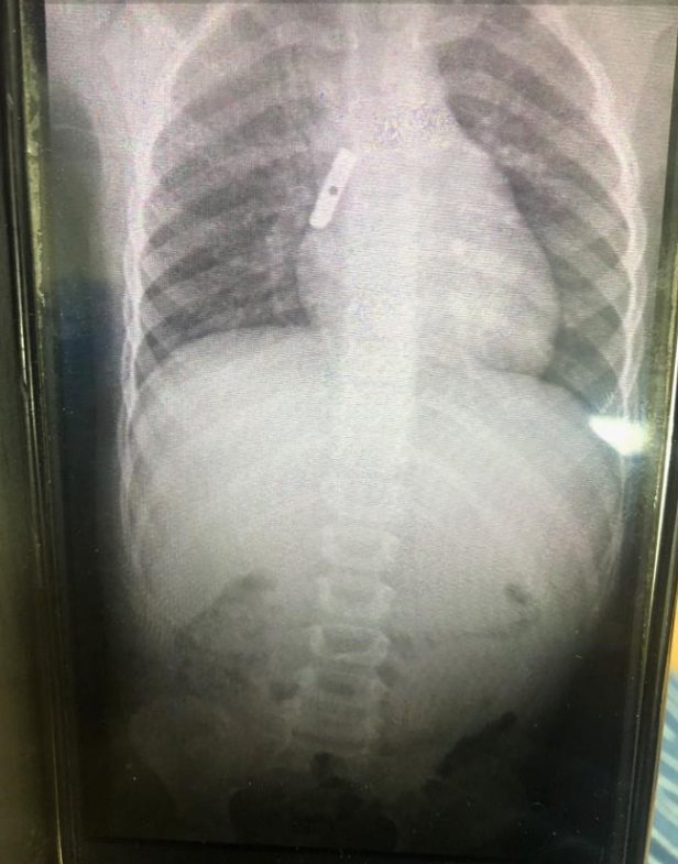 להב מחדד בצילום הרנטגן | צילום: סורוקה