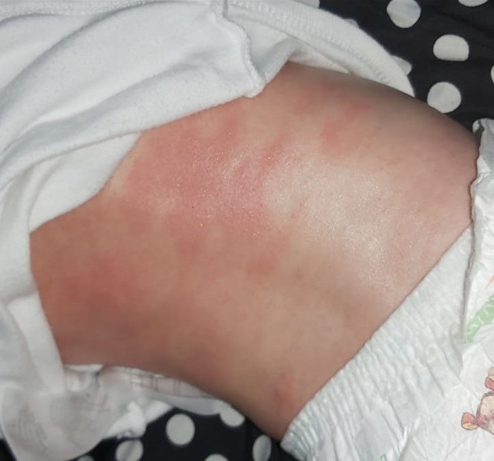 	 בנה של נטלי עם תגובה אלרגית. קרדיט - צילום פרטי