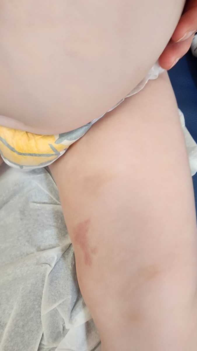 חבלות לכאורה על גופו של הפעוט. קרדיט: צילום פרטי