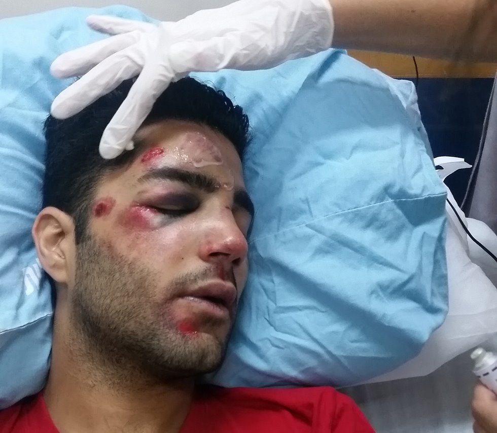 שבר את ארובת העין. צילום מתוך הפייסבוק