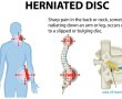 פריצת דיסק - כיצד לטפל בכאבי גב ולהימנע מהשלכות ארוכות טווח