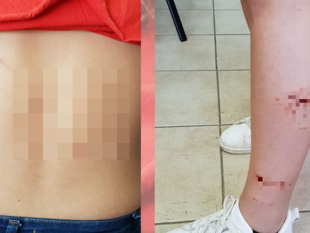 סימני התקיפה | צילום: פרטי